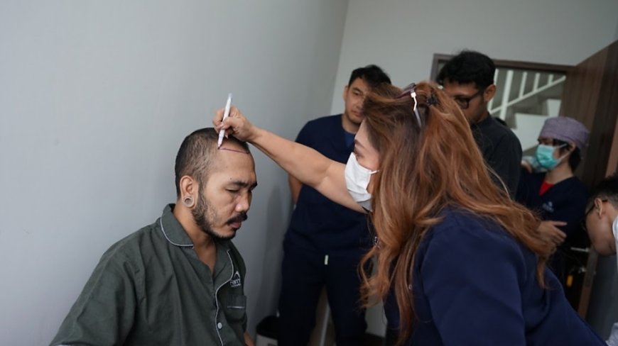 Farmanina Clinic Punya Jurus Sakti Atasi Kebotakan, Mau Tau?